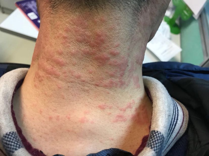 1、膏藥過敏怎么辦？