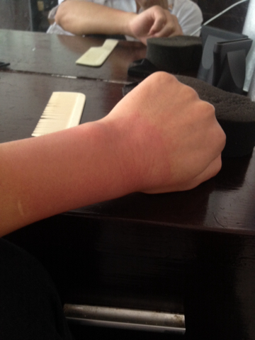 3、膏藥過敏的妙招是什么？