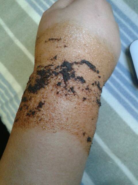 4、貼了兩個星期的膏藥。突然長了很多紅癢的疙瘩。原因是什么？還能繼續貼嗎？